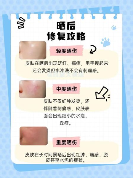 高原晒伤怎么办_高原晒伤多久恢复