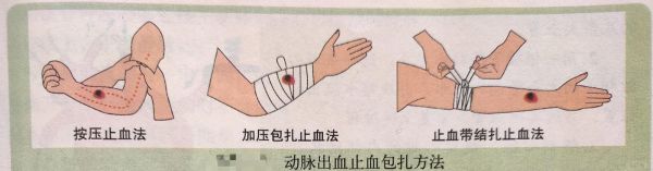 户外出血怎么办_野外止血急救步骤