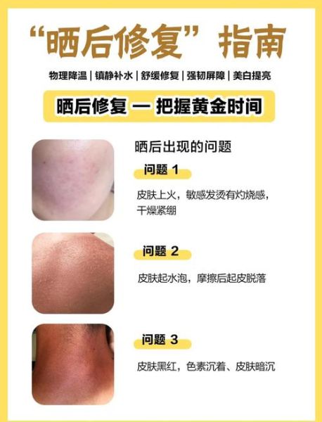 高原晒伤脱皮怎么办_高原晒伤后多久恢复