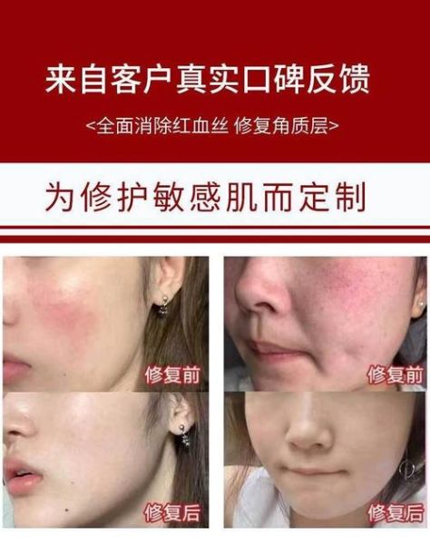 高原反应皮肤红怎么办_高原脸发红多久能退