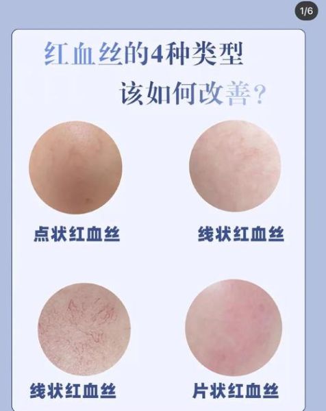 用盐洗脸能去高原红吗_多久见效