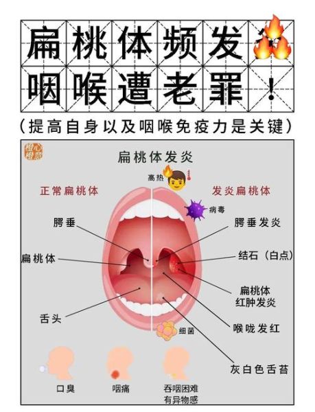 高原扁桃体发炎怎么办_高原旅行如何预防