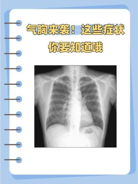 高原气胸症状_高原气胸如何预防