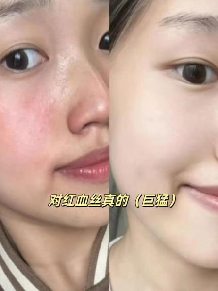 高原红怎么去掉_去除天生高原红的方法
