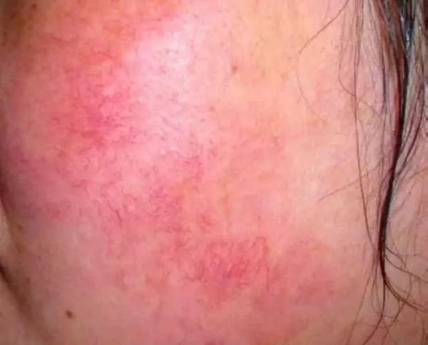 高原红长沙怎么治_高原红长沙会自愈吗