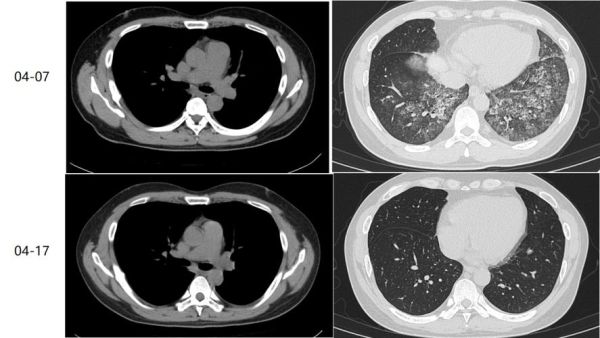 高原肺水肿多久能好_高原肺水肿恢复期多长