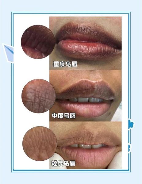 高原反应嘴唇发紫怎么办_高原反应嘴唇发紫严重吗